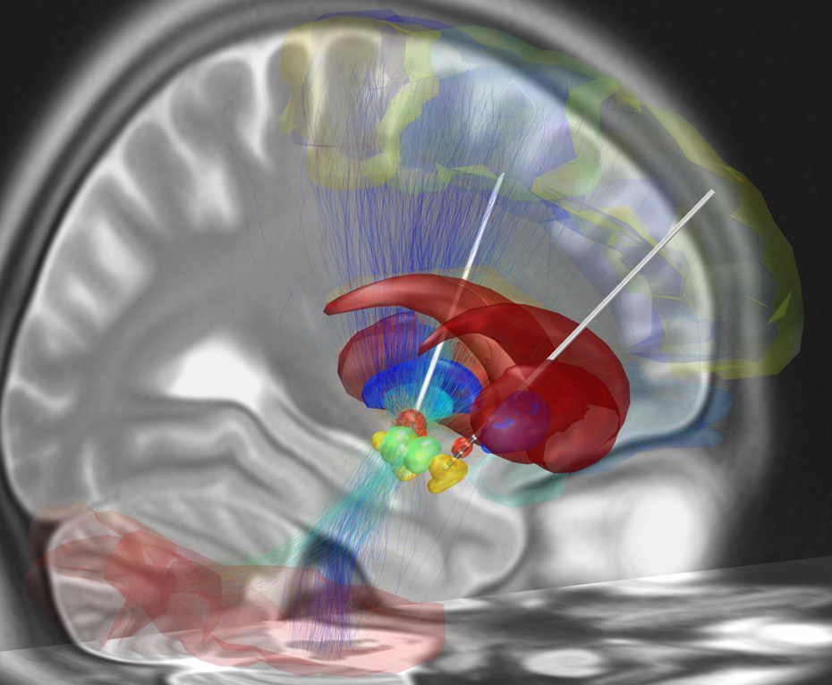 Reconstruction of deep brain stimulation leads placed in the subthalamic region, shown against a rendering of the surrounding brain structures.